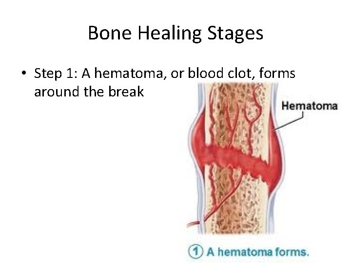Bone Healing Stages • Step 1: A hematoma, or blood clot, forms around the Bone Healing Stages • Step 1: A hematoma, or blood clot, forms around the