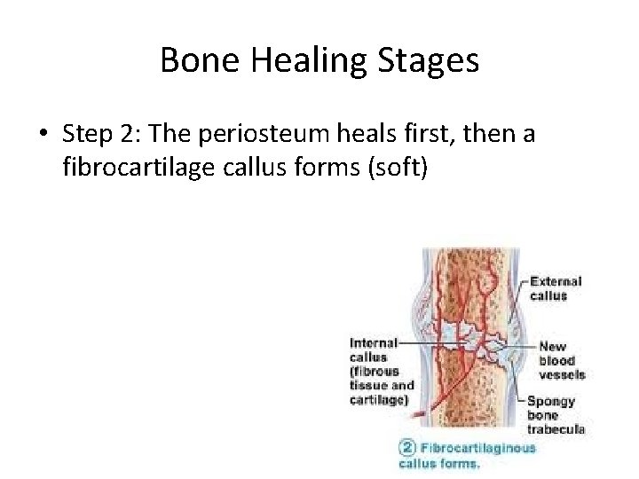 Bone Healing Stages • Step 2: The periosteum heals first, then a fibrocartilage callus Bone Healing Stages • Step 2: The periosteum heals first, then a fibrocartilage callus