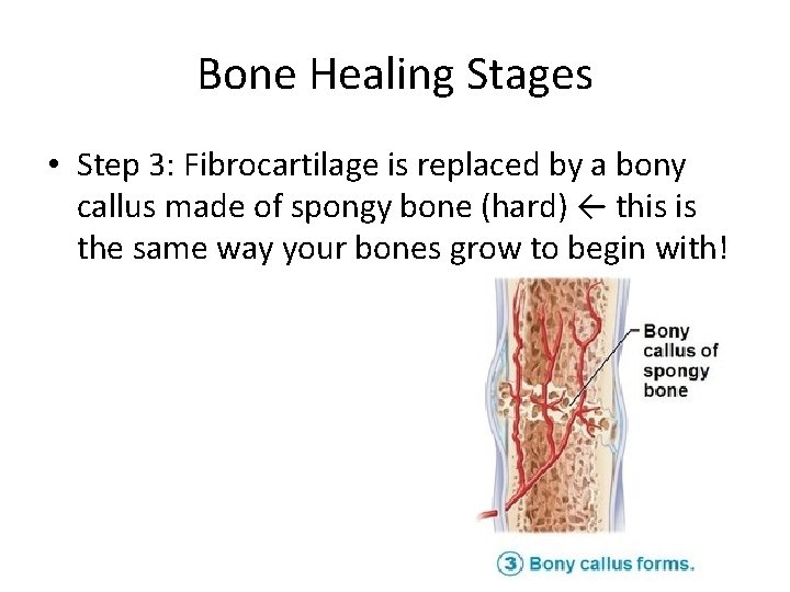 Bone Healing Stages • Step 3: Fibrocartilage is replaced by a bony callus made