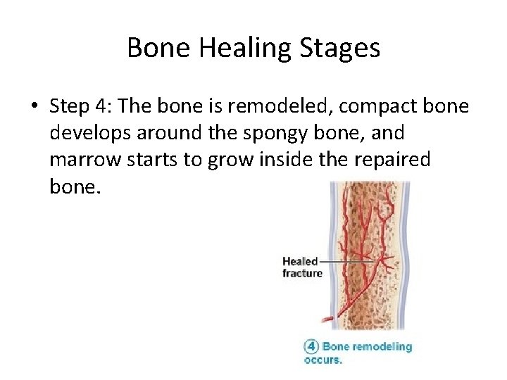 Bone Healing Stages • Step 4: The bone is remodeled, compact bone develops around Bone Healing Stages • Step 4: The bone is remodeled, compact bone develops around