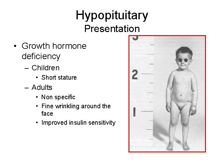 Hypopituitary Presentation • Growth hormone deficiency – Children • Short stature – Adults •