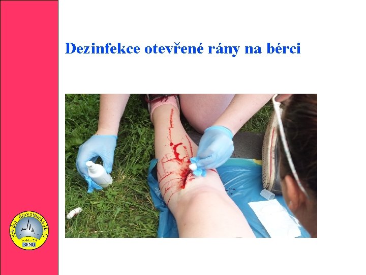 Dezinfekce otevřené rány na bérci 