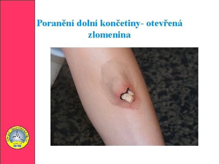 Poranění dolní končetiny- otevřená zlomenina 