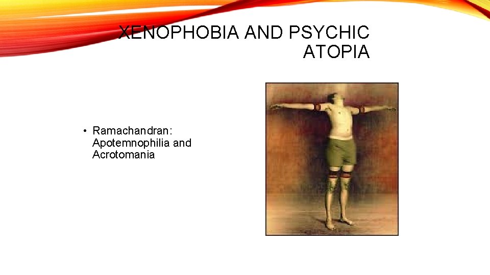 XENOPHOBIA AND PSYCHIC ATOPIA • Ramachandran: Apotemnophilia and Acrotomania 