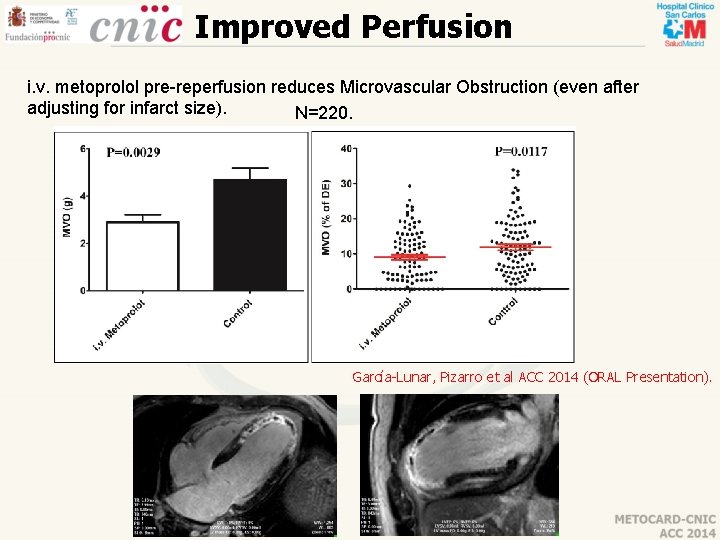 Improved Perfusion i. v. metoprolol pre-reperfusion reduces Microvascular Obstruction (even after adjusting for infarct