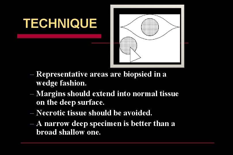 TECHNIQUE – Representative areas are biopsied in a wedge fashion. – Margins should extend