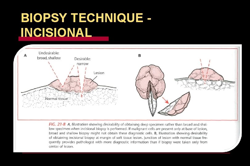 BIOPSY TECHNIQUE INCISIONAL 