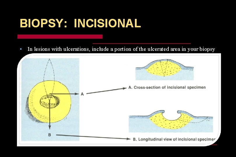 BIOPSY: INCISIONAL • In lesions with ulcerations, include a portion of the ulcerated area