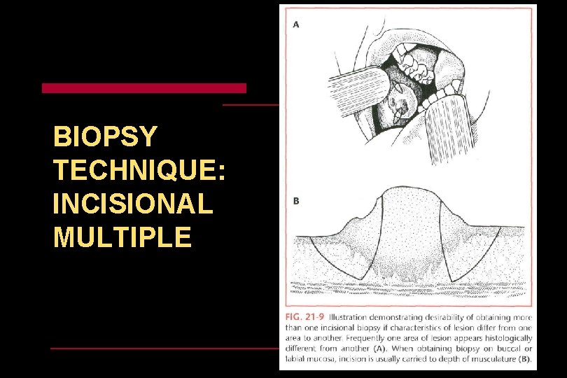 BIOPSY TECHNIQUE: INCISIONAL MULTIPLE 