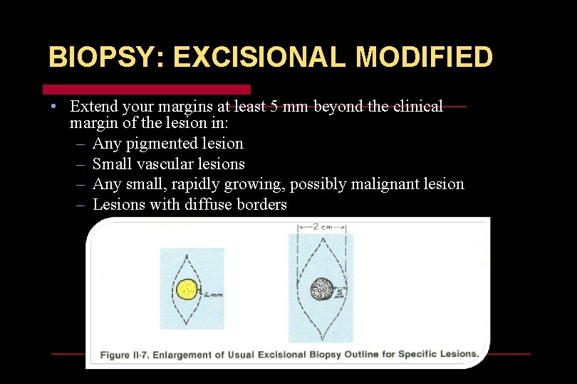 BIOPSY: EXCISIONAL MODIFIED • Extend your margins at least 5 mm beyond the clinical