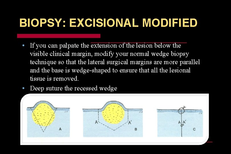 BIOPSY: EXCISIONAL MODIFIED • If you can palpate the extension of the lesion below