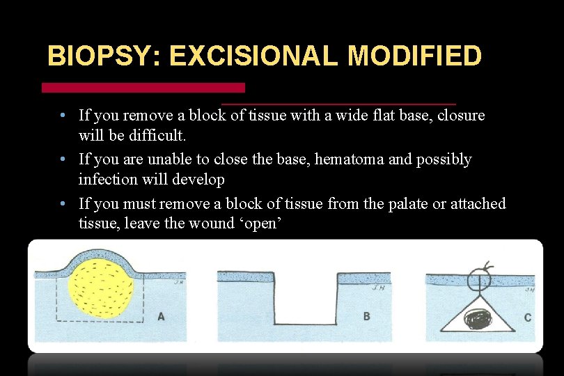 BIOPSY: EXCISIONAL MODIFIED • If you remove a block of tissue with a wide