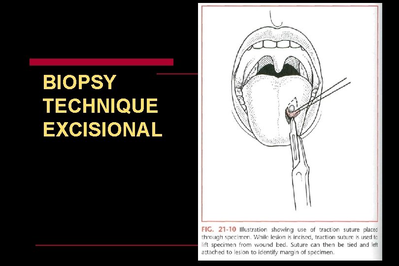 BIOPSY TECHNIQUE EXCISIONAL 