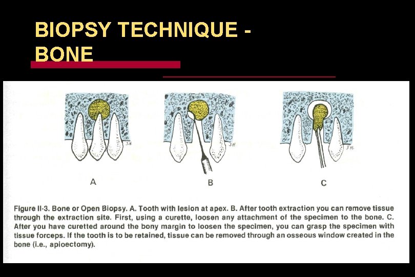 BIOPSY TECHNIQUE BONE 