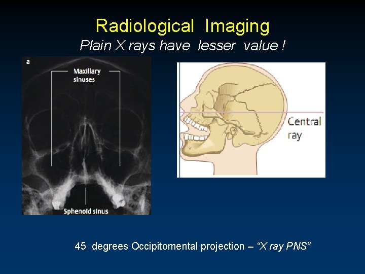 Radiological Imaging Plain X rays have lesser value ! 45 degrees Occipitomental projection –
