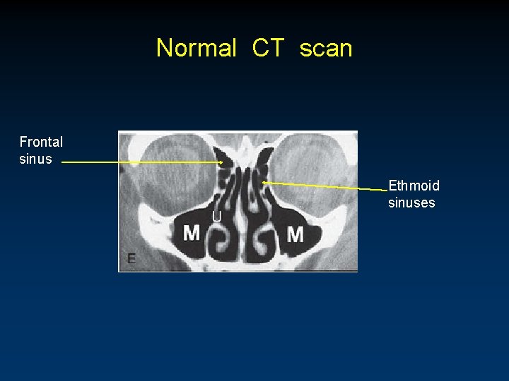 Normal CT scan Frontal sinus Ethmoid sinuses 