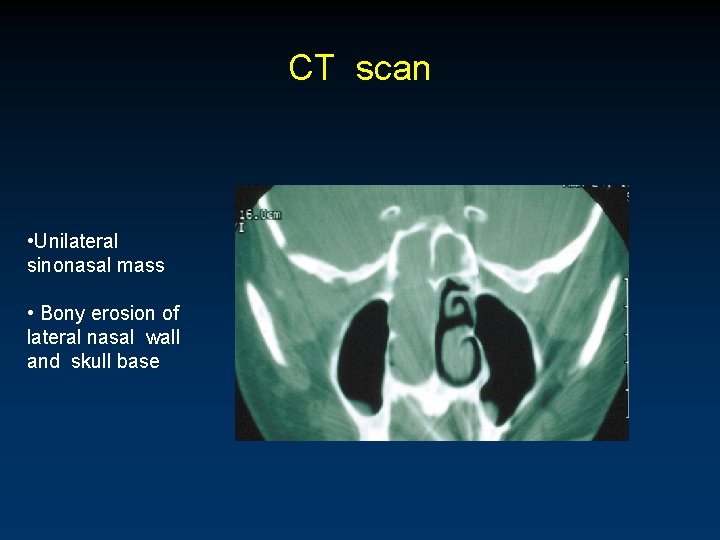 CT scan • Unilateral sinonasal mass • Bony erosion of lateral nasal wall and