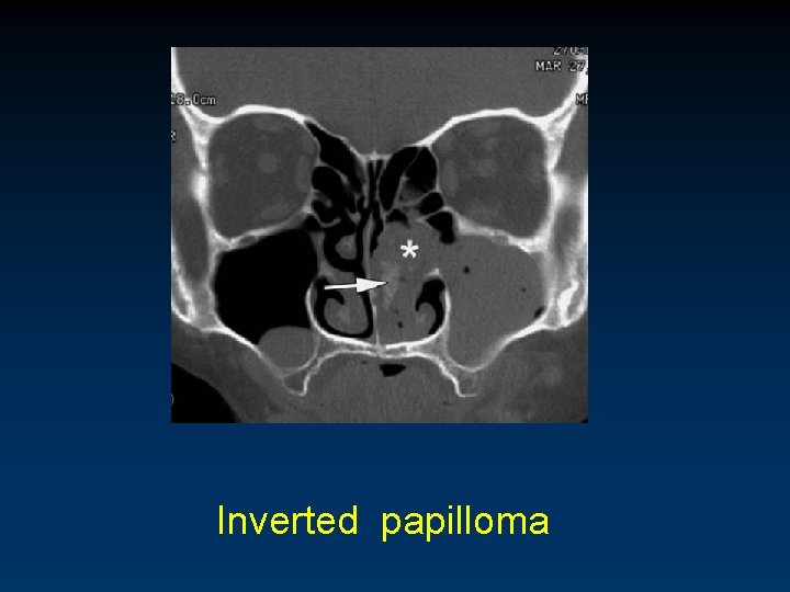 Inverted papilloma 