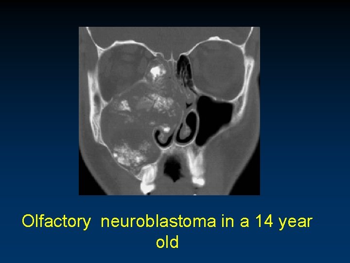 Olfactory neuroblastoma in a 14 year old 