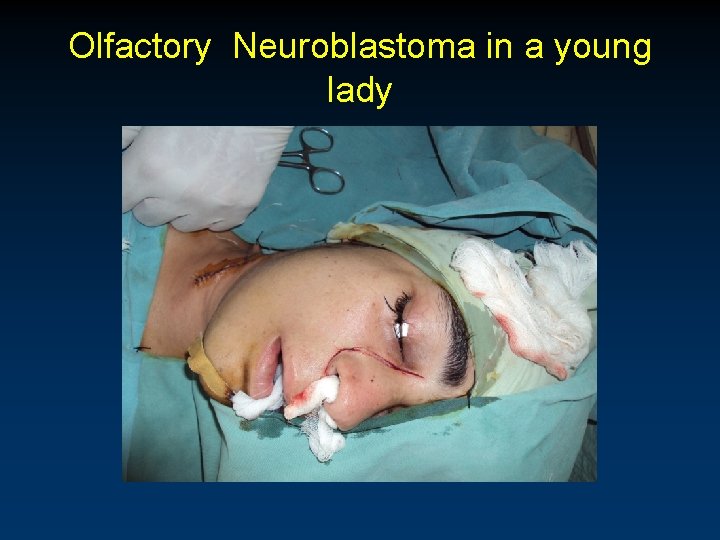 Olfactory Neuroblastoma in a young lady 