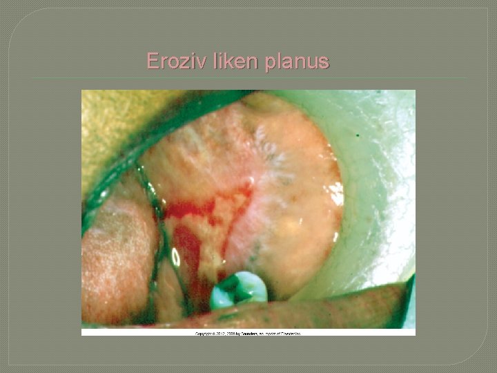  Eroziv liken planus 