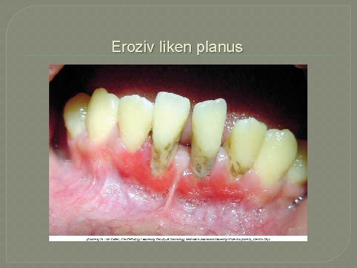  Eroziv liken planus 