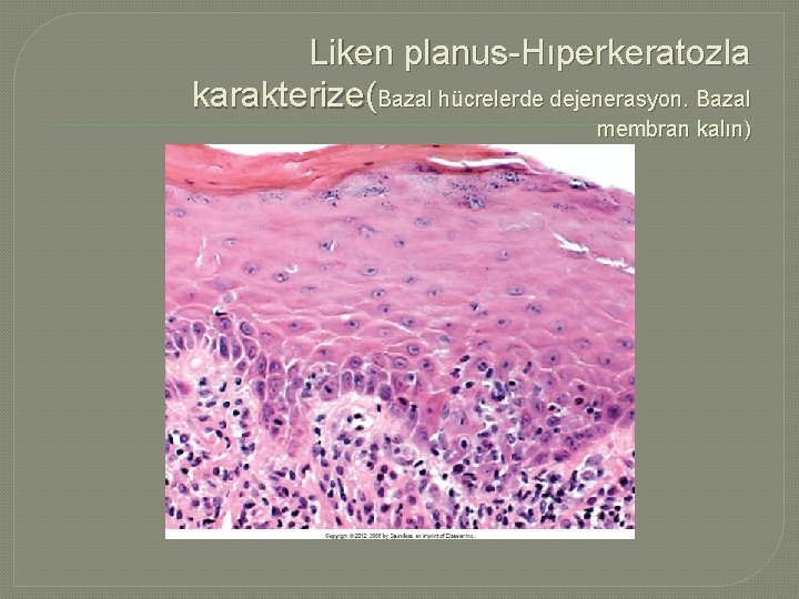 Liken planus-Hıperkeratozla karakterize(Bazal hücrelerde dejenerasyon. Bazal membran kalın) 