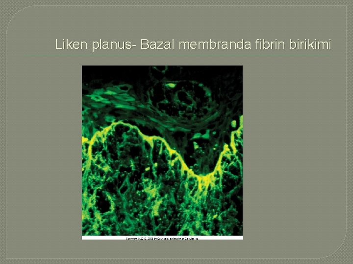 Liken planus- Bazal membranda fibrin birikimi 
