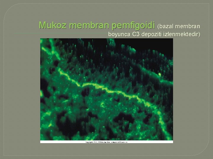 Mukoz membran pemfigoidi (bazal membran boyunca C 3 depoziti izlenmektedir) 