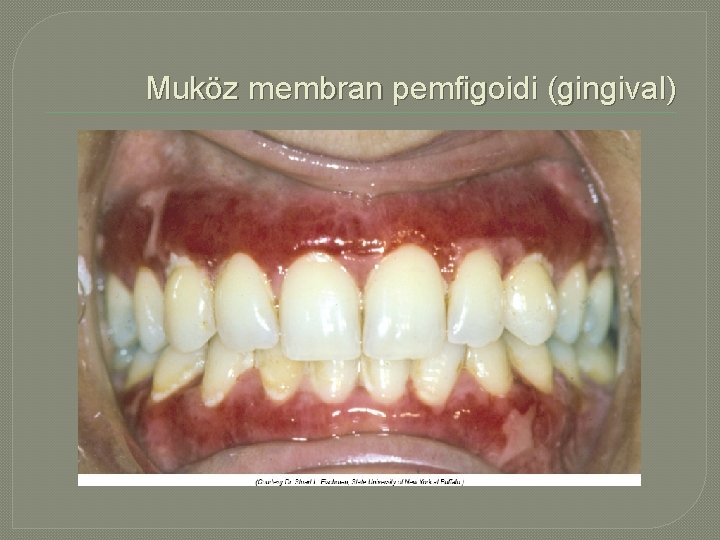 Muköz membran pemfigoidi (gingival) 