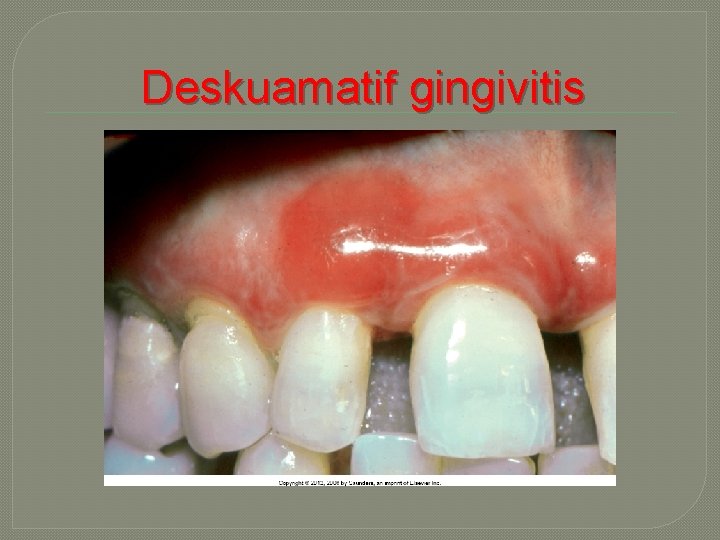 Deskuamatif gingivitis 