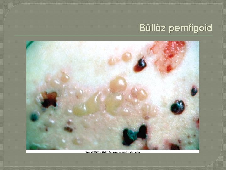 Büllöz pemfigoid 