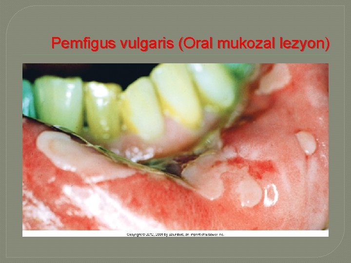 Pemfigus vulgaris (Oral mukozal lezyon) 