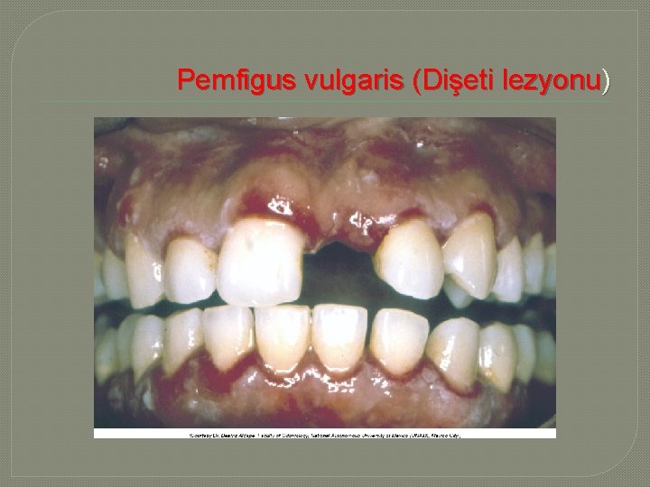  Pemfigus vulgaris (Dişeti lezyonu) 