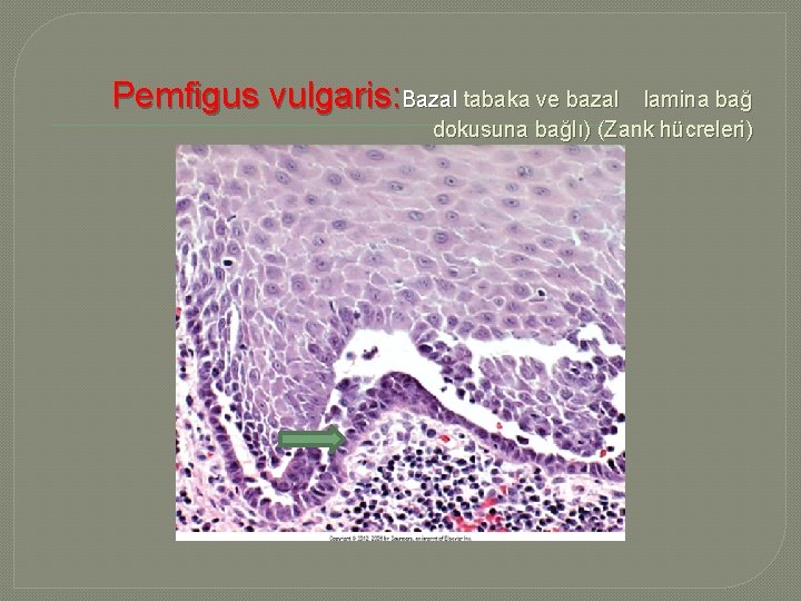 Pemfigus vulgaris: Bazal tabaka ve bazal lamina bağ dokusuna bağlı) (Zank hücreleri) 