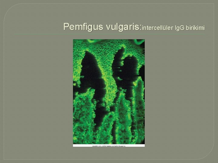 Pemfigus vulgaris: intercellüler Ig. G birikimi 