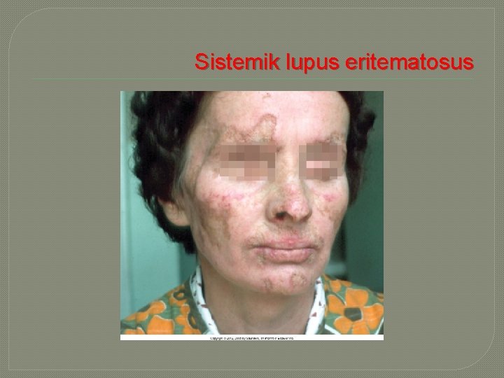  Sistemik lupus eritematosus 