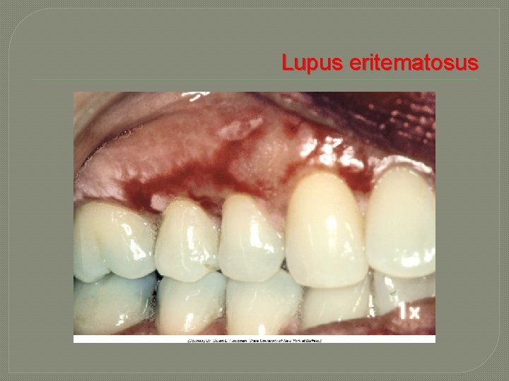  Lupus eritematosus 