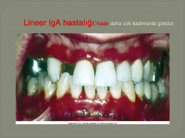 Lineer Ig. A hastalığı: Nadir daha cok kadınlarda görülür 