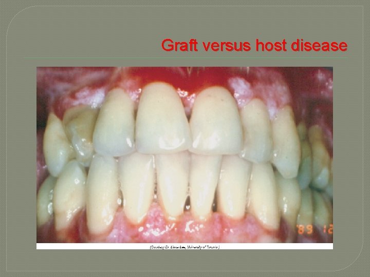 Graft versus host disease 