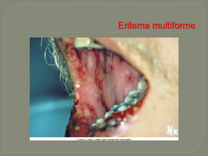  Eritema multiforme 