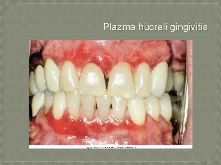  Plazma hücreli gingivitis 