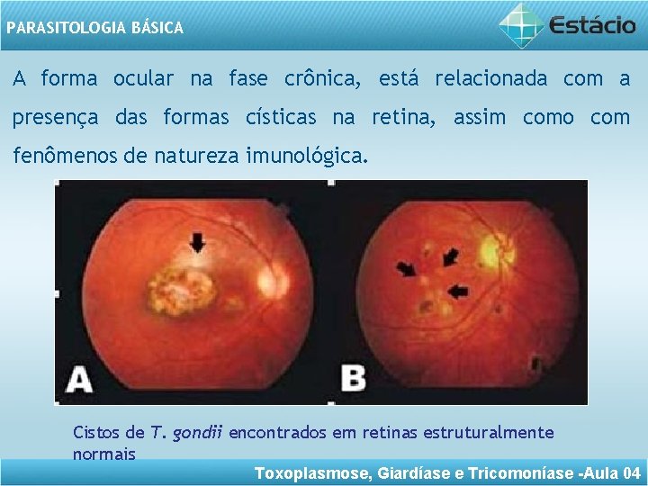 PARASITOLOGIA BÁSICA A forma ocular na fase crônica, está relacionada com a presença das