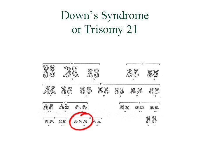 Down’s Syndrome or Trisomy 21 