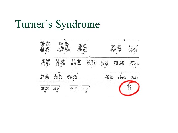Turner’s Syndrome 