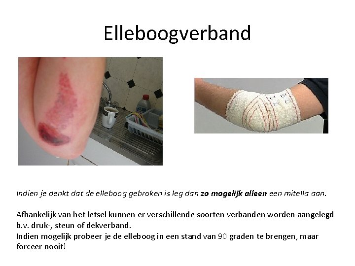 Elleboogverband Indien je denkt dat de elleboog gebroken is leg dan zo mogelijk alleen