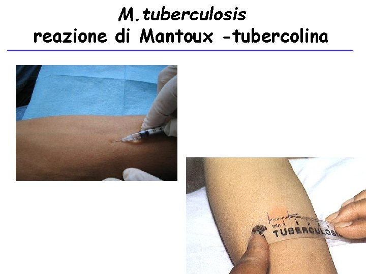 M. tuberculosis reazione di Mantoux -tubercolina 24 