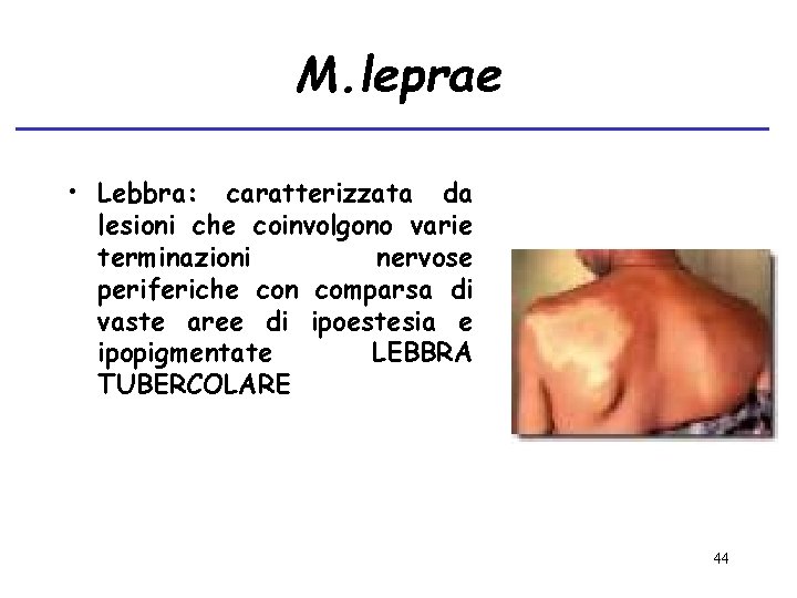 M. leprae • Lebbra: caratterizzata da lesioni che coinvolgono varie terminazioni nervose periferiche con