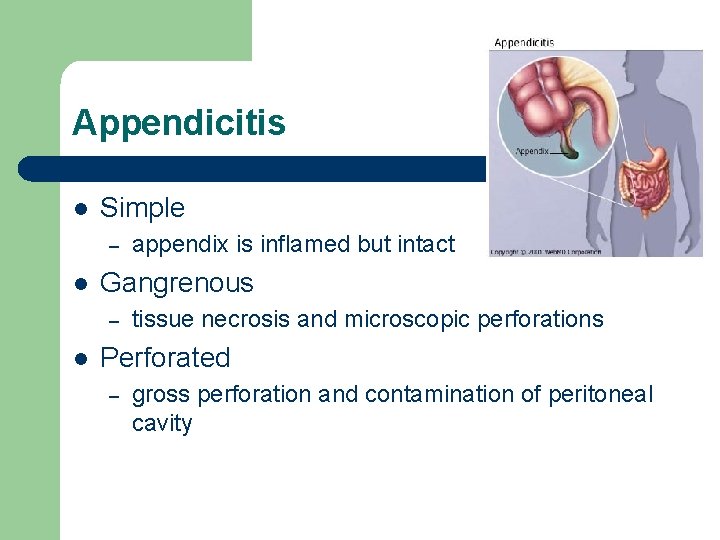 Appendicitis l Simple – l Gangrenous – l appendix is inflamed but intact tissue