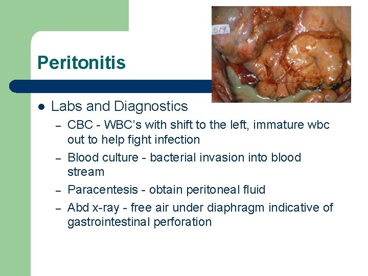 Peritonitis l Labs and Diagnostics – – CBC - WBC’s with shift to the